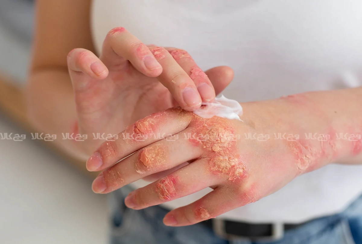 درماتیت هرپتیفورمیس DH نشانه هشداردهنده حساسیت به گلوتن