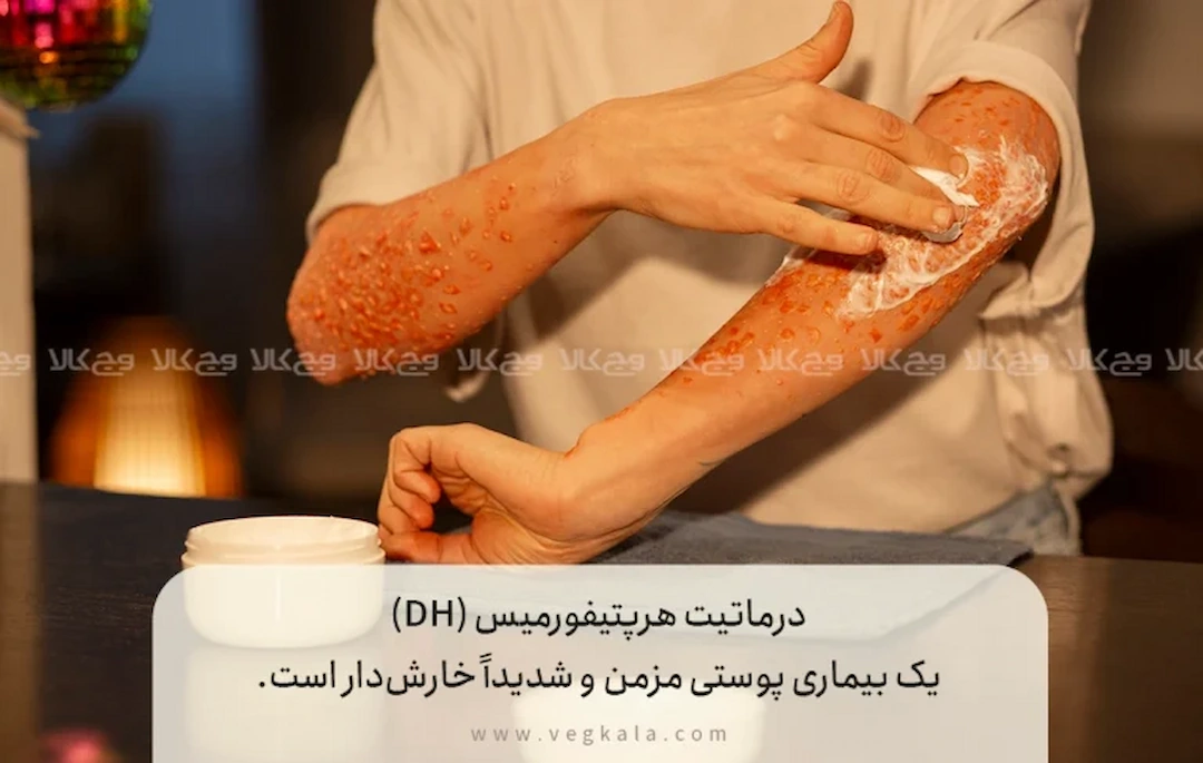 علائم و نشانه‌های کلیدی درماتیت هرپتیفورمیس DH