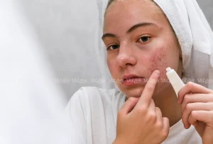 روتین مراقبت پوست جوشدار با محصولات گیاهی و فاقد تست حیوانی